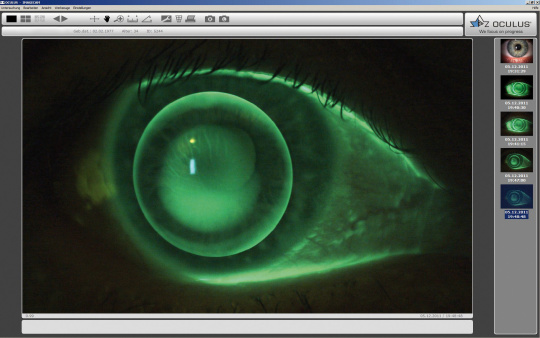 Green fluorescein image of an eye on a screen.