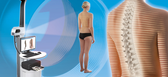 Optical spine and posture analysis with uEye industrial cameras