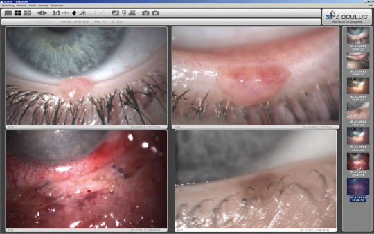 Images of different stages of an eye disease on a screen for monitoring progress